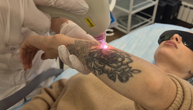Лазерное удаление татуировок Q-switch Nd:Yag Lumenis M22