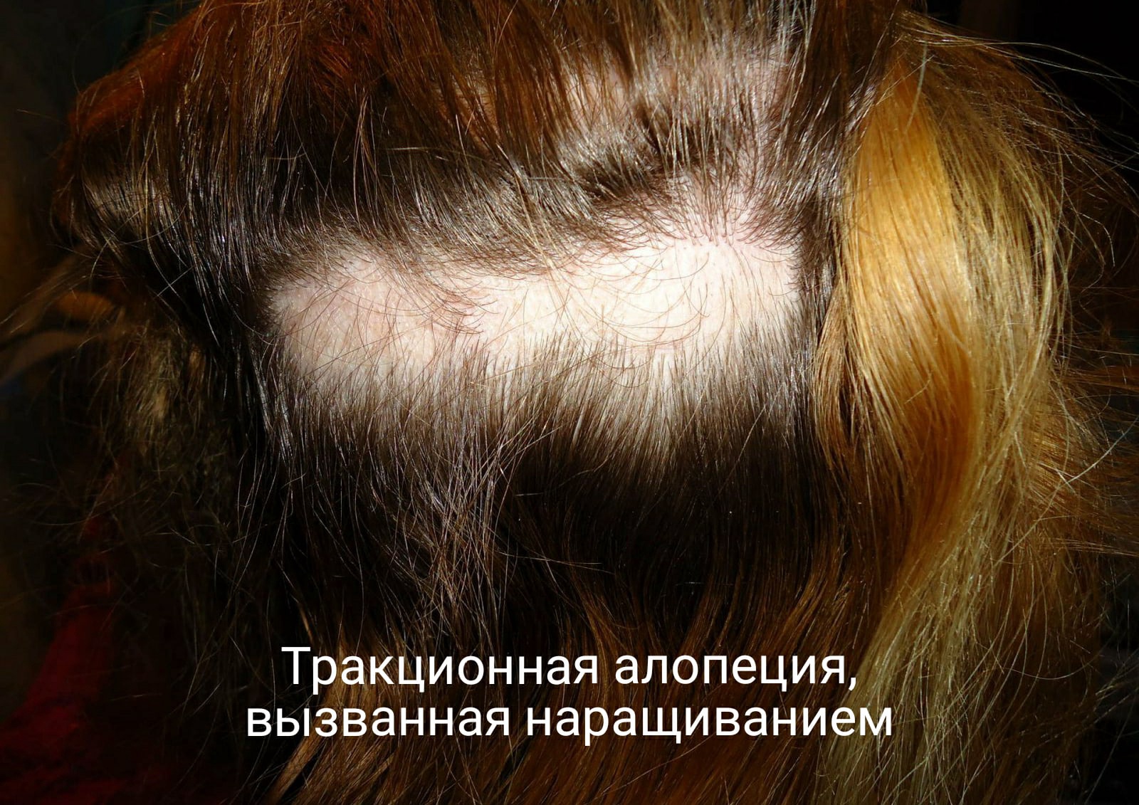 Наращивание волос и алопеция: есть ли связь?