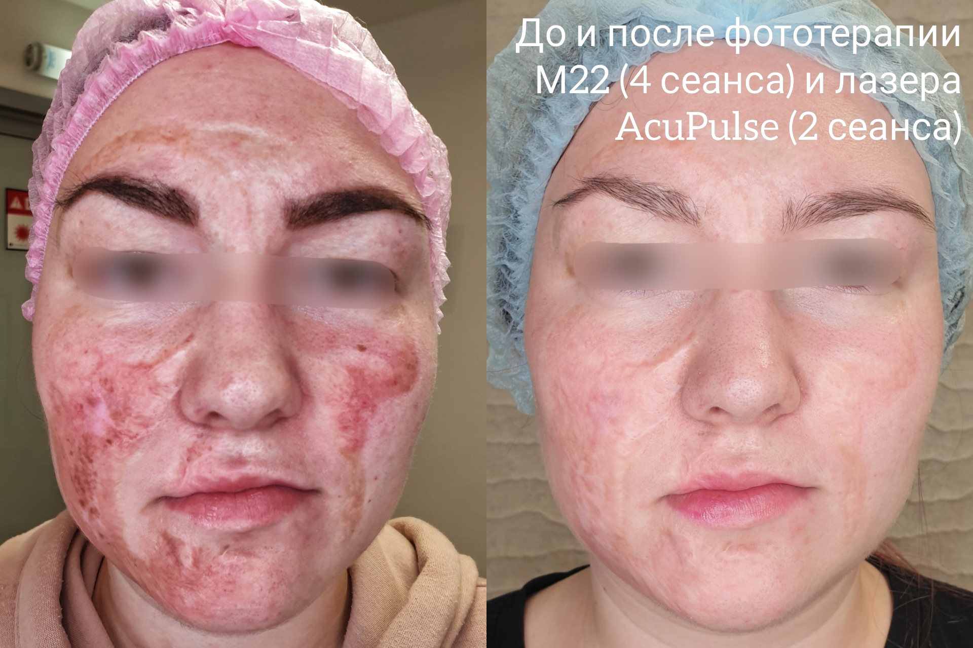 Лечение рубцов и шрамов на лице